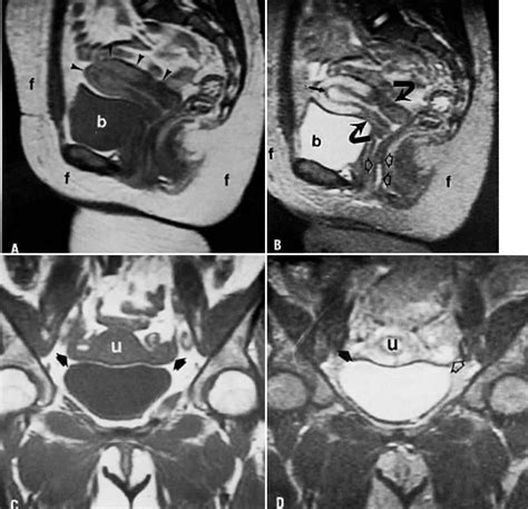 MRI Atlas | GLOWM Endometrial Carcinoma, Endometrial Cancer, Ovarian Cyst, Cervical Cancer ...