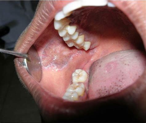 Oral Lichen Planus and the Burning Mouth Syndrome Treatment (2022)