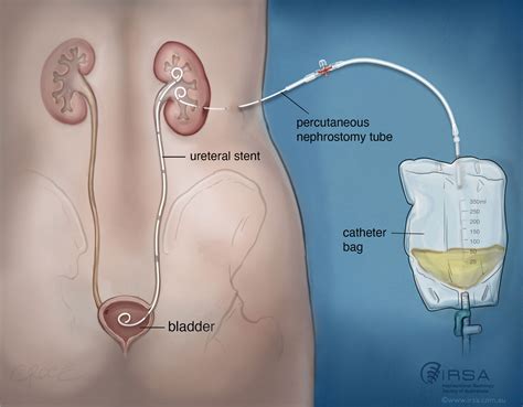 Nephrostomy | Interventional Radiology Procedure for Kidney Care