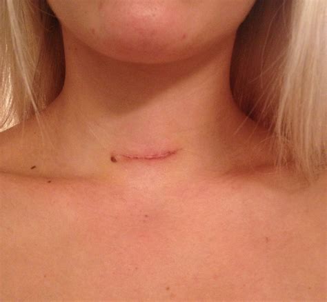 real talk: my thyroidectomy scar update - Holy City Chic