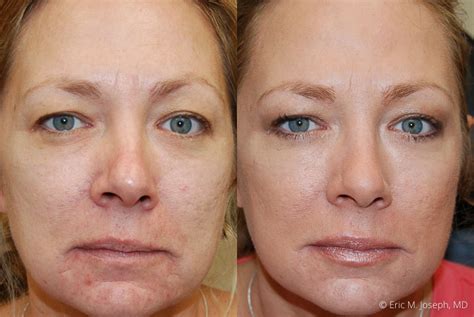 Eric M. Joseph, MD | Botox Before & After: Frown Line Reduction