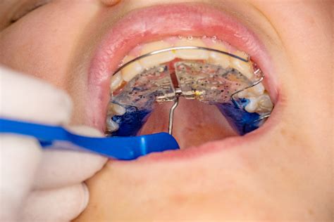 How a Palatal Expander Works - Braces By Abbadent Dubuque, IA