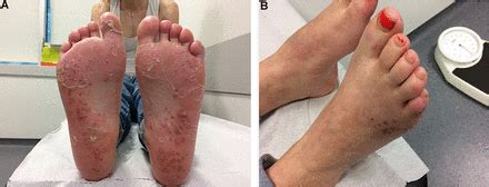 Keratoderma blennorrhagica | BMJ Case Reports