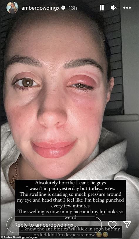 TOWIE star Amber Dowding is rushed to hospital as she shares shocking photos of her swollen face ...