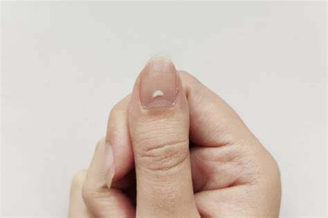 Here's What It Means if You Have White Spots on Your Nails | The Healthy