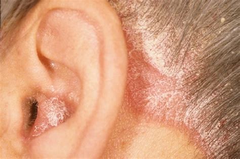 Signs And Symptoms Of Psoriasis In The Ears!