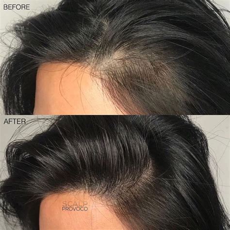 SMP for Women Experiencing Hair Loss & Thinning | Scalp Provoco