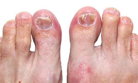 Images Of Toenail Fungus : Causes and Treatments of Toenail Fungus - The Beltsville ... : Best ...