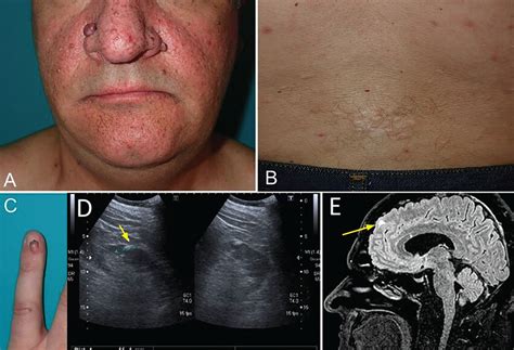 Tuberous sclerosis complex | Cleveland Clinic Journal of Medicine