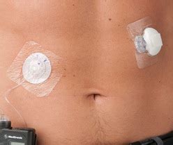 Pump Accessories | IE | Medtronic Diabetes