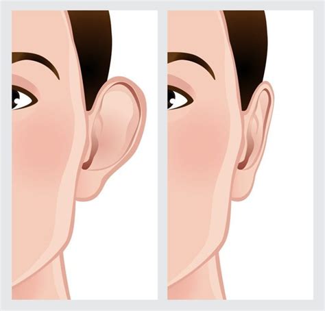 Best Ear Surgery (Otoplasty) Raleigh, NC | Allen Aesthetic Surgery