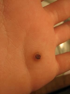 Is It Normal If Wart Turned Black After Freezing? | New Health Advisor