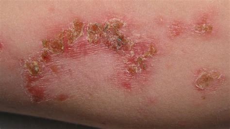 Purulent skin infections – the most common skin diseases. How to fight ...