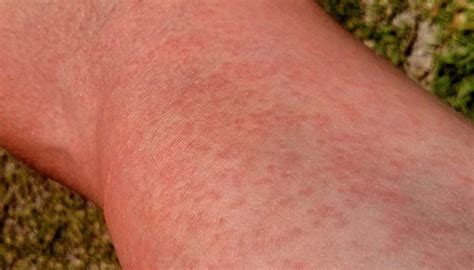 Maculopapular rash: Causes, treatment, and pictures