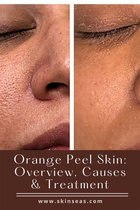 How To Fix Large Pores (Orange peel Skin) in 2021 | Orange peel skin ...