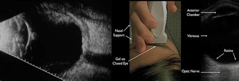 Ocular Imaging (Eye ultrasound or B-scan) - Radiology Nagpur