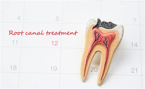 Root Canal Procedure | Who Performs it and What Does it Cost?