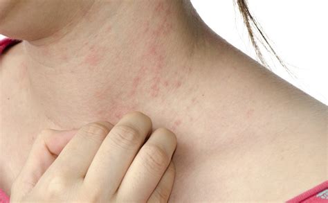 Qué es la dermatitis herpetiforme - Bekia Salud