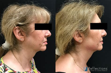 Jawline Filler for Woman in Her 60s Before & After Photos New Jersey - Reflections Center