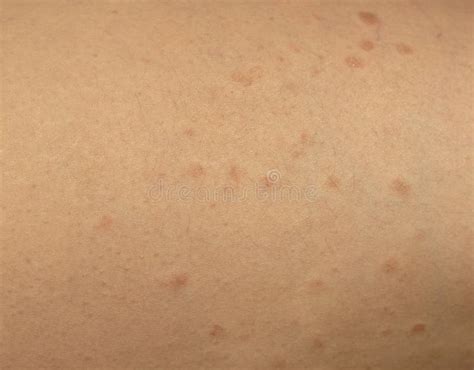 Burn Spots from Laser Skin Treatment for Body Hair Removal. Burns Stock Photo - Image of ...