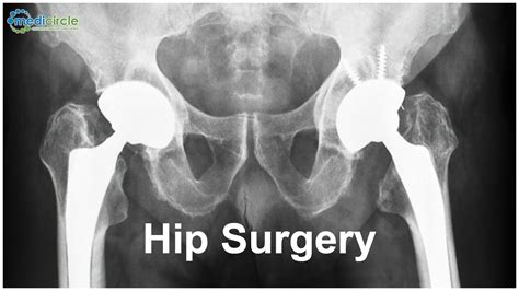 Accelerated time to Hip surgery reduces other complications