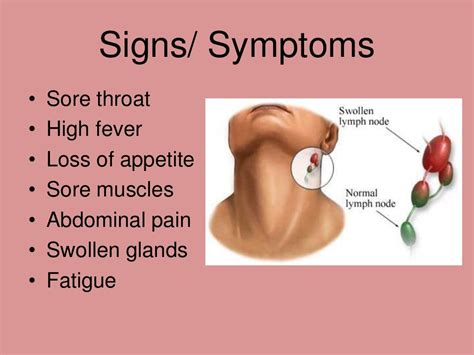 Mononucleosis matthews