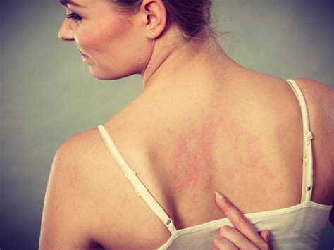 Vitamin D supplementation may improve eczema symptoms, researchers say