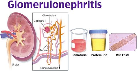 Rosh Review | Bright's disease, Medical mnemonics, Medical laboratory ...