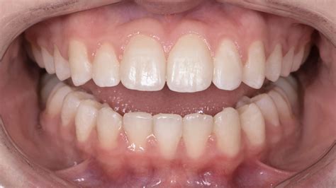 Lower Incisor Extraction: An Alternative Approach — e-LINE Orthodontics