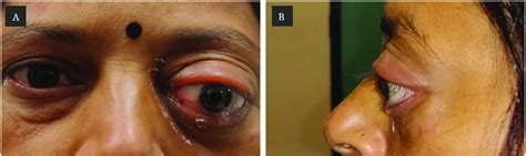 Clinical photograph at presentation showing severe proptosis of the... | Download Scientific Diagram