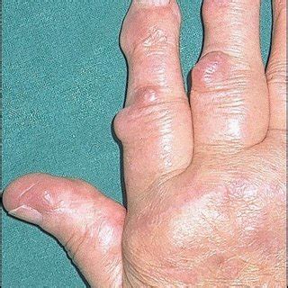 (16-year-old girl, chronic plantar metatarsalgia, left): Symptoms are... | Download Scientific ...