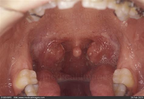 STOCK IMAGE, erythematous reddened and pultaceous pulpy tonsillitis an inflammation of the ...