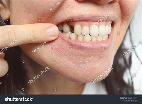 Asian Woman Missing Front Tooth Problem Stock Photo 2090375797 | Shutterstock