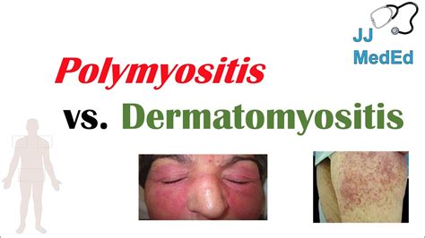 Idiopathic Inflammatory Myopathies | Polymyositis vs Dermatomyositis ...