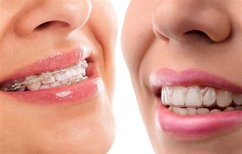 Invisalign Doctor Site (Top Provider Near Me) | Schaumburg Dentistry