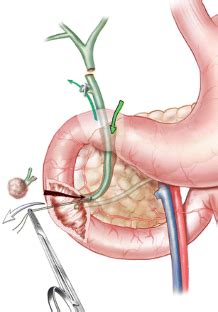 Surgical Ampullectomy with Complete Resection of the Common Bile Duct ...