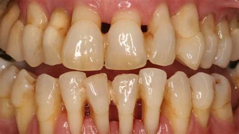 The 9-Second Trick For Gum Disease Pictures: What Do Healthy Gums Look ...