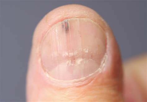 early stage nail cancer pictures | Symptoms and pictures