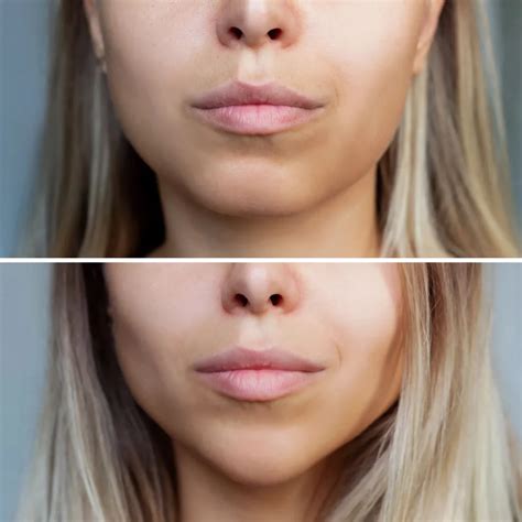 Sculptra Jawline Before and After Use Transformations