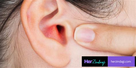 Symptoms And Home Treatment For Boil In Ear-कान में फुंसी निकल आए तो ...