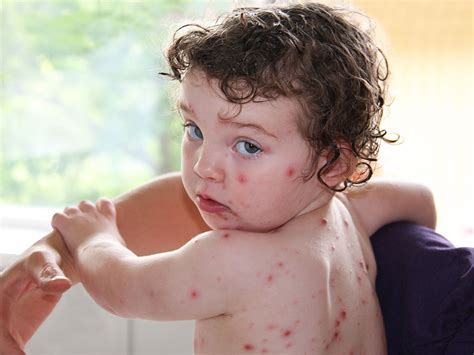 Start Of Chicken Pox On Babies - Goimages 411