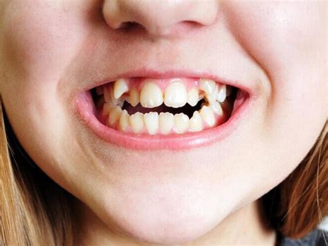 Are crooked teeth beautiful or ugly? Should crooked teeth be extracted? | Vinmec