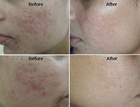 Acne Scars Before And After Dermaroller - shearlingwomenbestquality