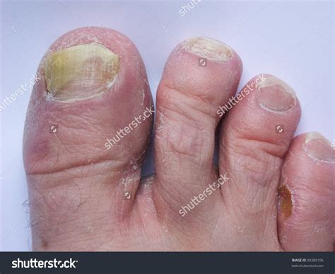 File:Alipunga - Athlete's foot.jpg - Philippines