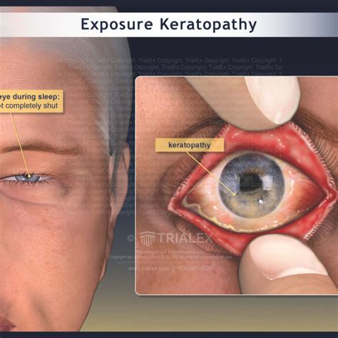 Exposure Keratopathy - TrialExhibits Inc.