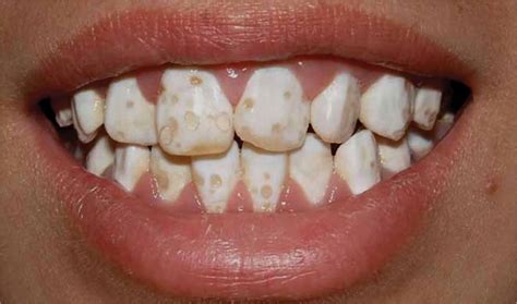 Contoh Tanda Tangan Huruf Enamel Hypoplasia Vs Fluorosis - IMAGESEE