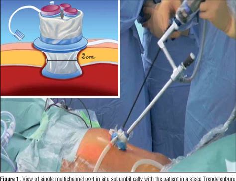 Figure 1 from Single-access laparoscopic sigmoidectomy as definitive surgical management of ...