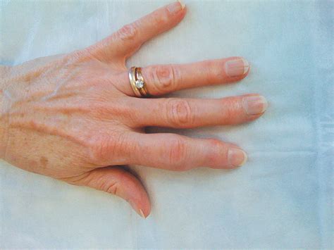 Онемение участка кожи на пальце руки - фото презентация