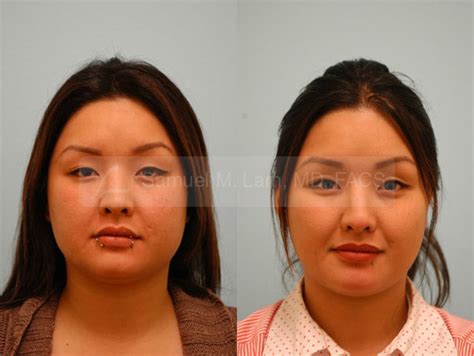 Dallas [ Botox Jaw Reduction ] Before and After Photos - Plano Plastic ...