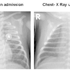 Chest X-rays showing bilateral patchy infiltrates due to pulmonary... | Download Scientific Diagram